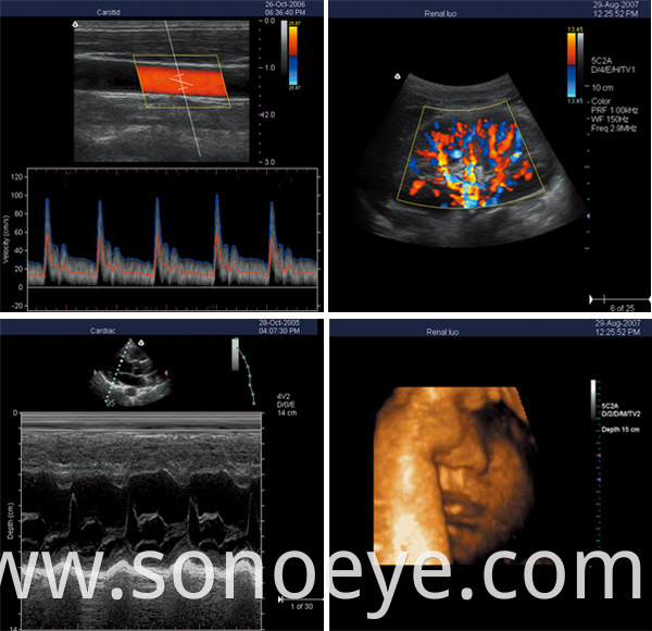 Trolley Type Ultrasound Scanner